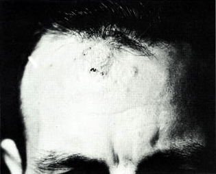 File:Coccidioidomycosis granulomas on forehead.png