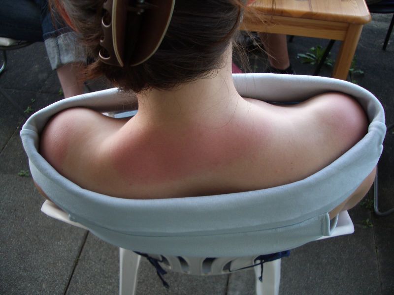 File:Sunburnt neck and shoulders.jpg
