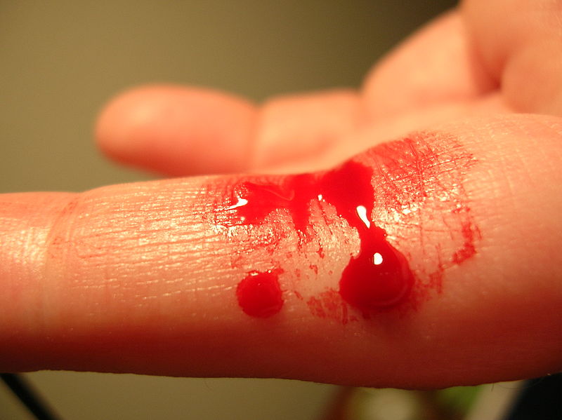 File:Bleeding finger.jpg